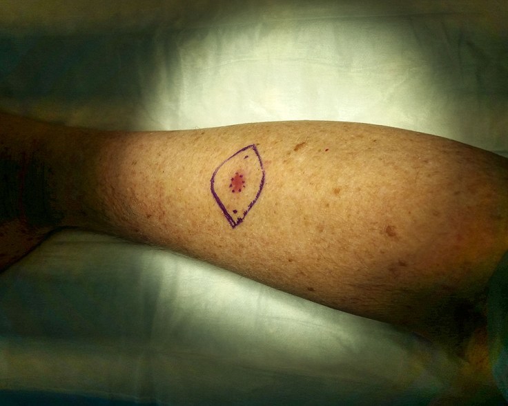 2019-06-28 Melanoma surgery_144314